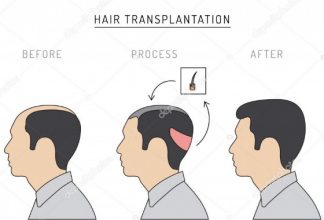 Hair transplant Turkey forum