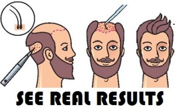 hair transplant Turkey results