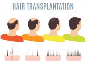 hair transplant in Turkey best clinics