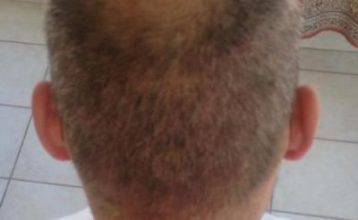 alopecia treatment (1)