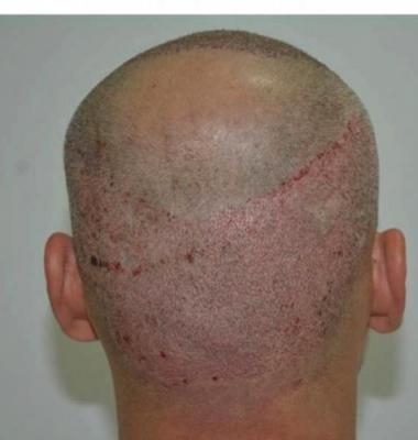 alopecia treatment (2)