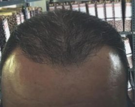 alopecia treatment (3)