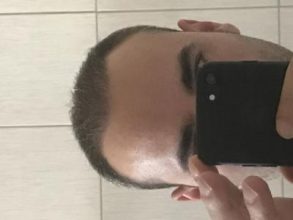 alopecia treatment (4)