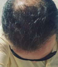 alopecia treatment (5)