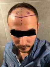 best hair transplant clinic in turkey (1)