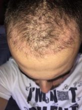 best hair transplant clinic in turkey (10)