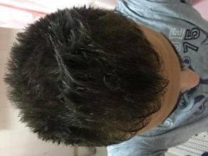 best hair transplant clinic in turkey (11)