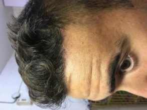 best hair transplant clinic in turkey (12)