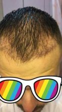 best hair transplant clinic in turkey (13)