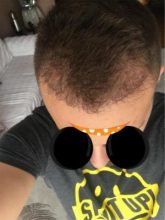 best hair transplant clinic in turkey (14)