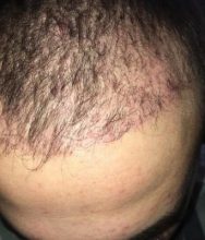 best hair transplant clinic in turkey (15)