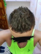 best hair transplant clinic in turkey (16)