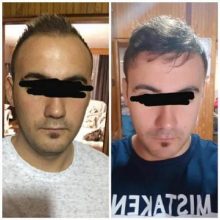 best-hair-transplant-clinic-in-turkey