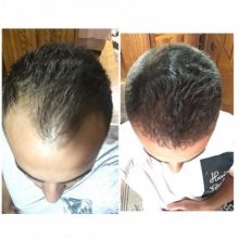 best hair transplant clinic in turkey (18)