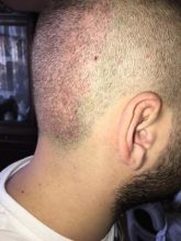 best hair transplant clinic in turkey (19)