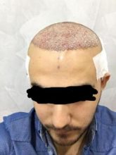 best hair transplant clinic in turkey (2)