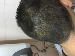best hair transplant clinic in turkey (20)
