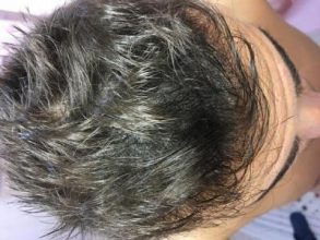 best hair transplant clinic in turkey (21)