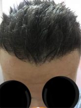 best hair transplant clinic in turkey (5)