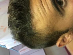 best hair transplant clinic in turkey (6)