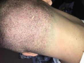 best hair transplant clinic in turkey (7)