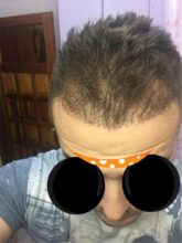 best hair transplant clinic in turkey (8)