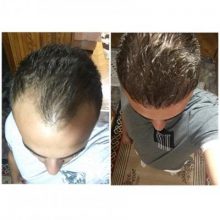 best hair transplant clinic in turkey (9)