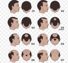 best hair transplant in turkey