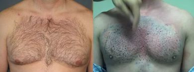 body hair transplant