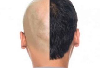 fue hair cost in turkey
