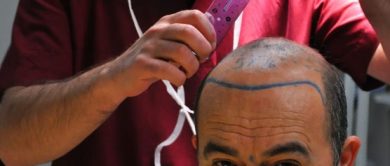 fue hair transplant in Turkey