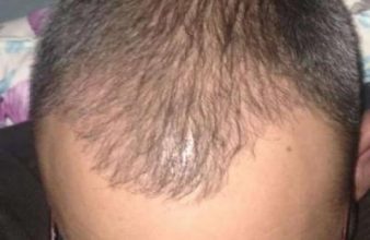 hair fall treatment (1)