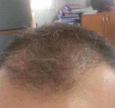 hair fall treatment (3)