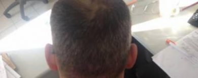 hair fall treatment (4)