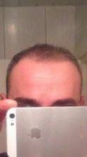 hair fall treatment (5)