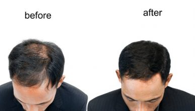 hair implant in turkey