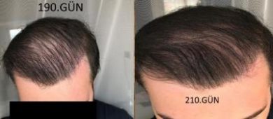 hair implant turkey istanbul (29)