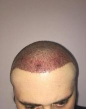 hair implants turkey (1)