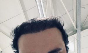 hair transplant results