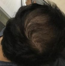 hair implants turkey (10)