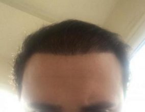hair implants turkey (11)