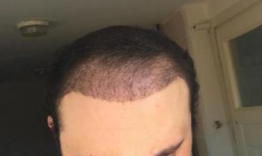 hair implants turkey (12)