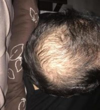 hair implants turkey (13)