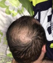 hair implants turkey (14)