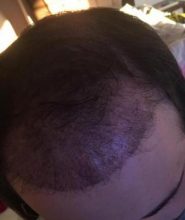hair implants turkey (15)