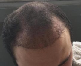 hair implants turkey (16)