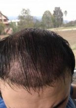hair implants turkey (17)