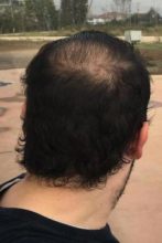 hair implants turkey (18)
