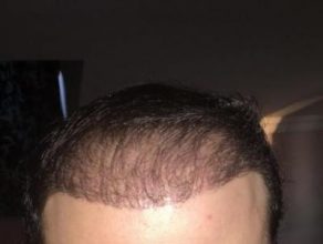 hair implants turkey (19)