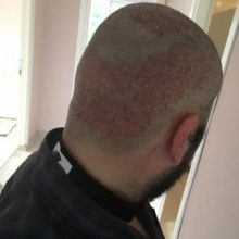 hair implants turkey (2)